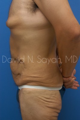 Tummy Tuck Before and After | simply males