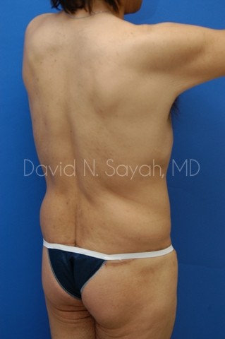 Tummy Tuck Before and After | simply males