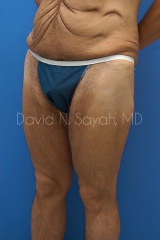 Tummy Tuck Before and After | simply males