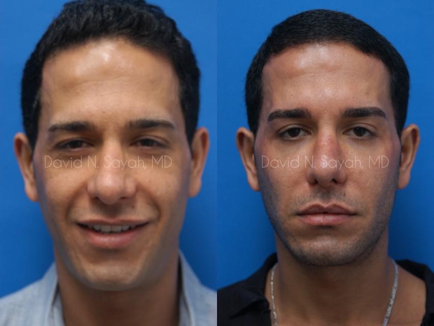 Eyelid Surgery Before and After | simply males