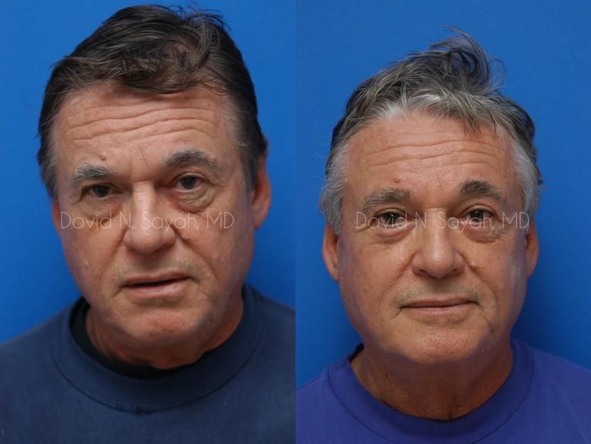 Eyelid Surgery Before and After | simply males