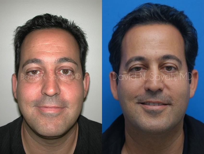Eyelid Surgery Before and After | simply males