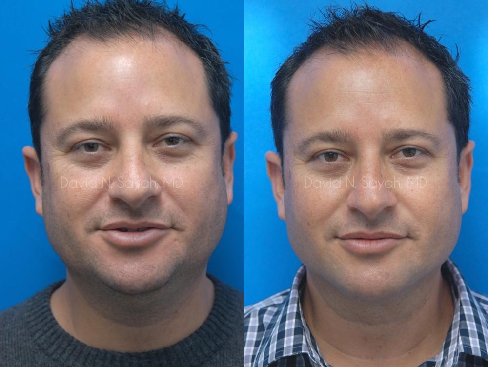 Neck Lift Before and After | simply males