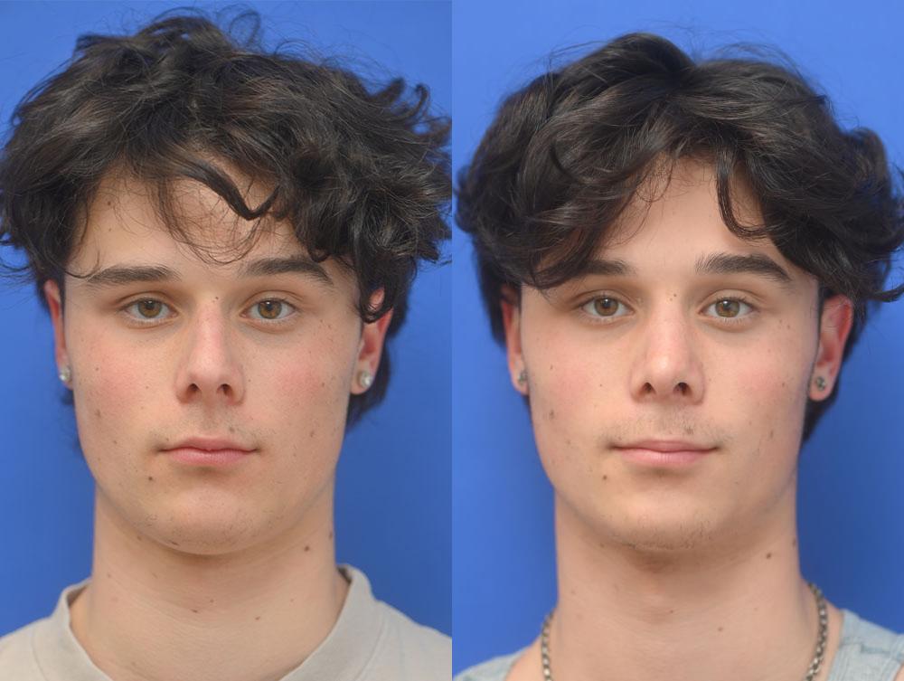Rhinoplasty Before and After | simply males
