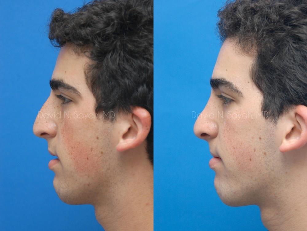 Rhinoplasty Before and After | simply males