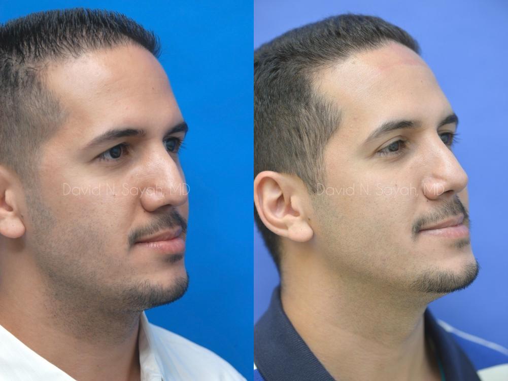 Rhinoplasty Before and After | simply males