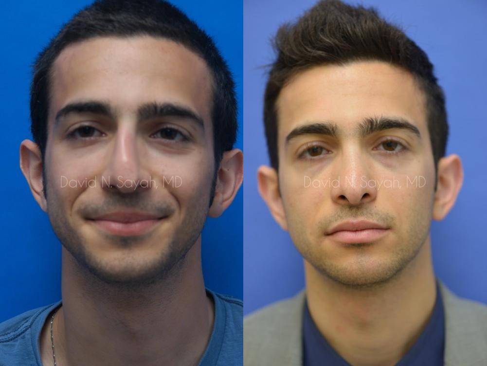 Rhinoplasty Before and After | simply males