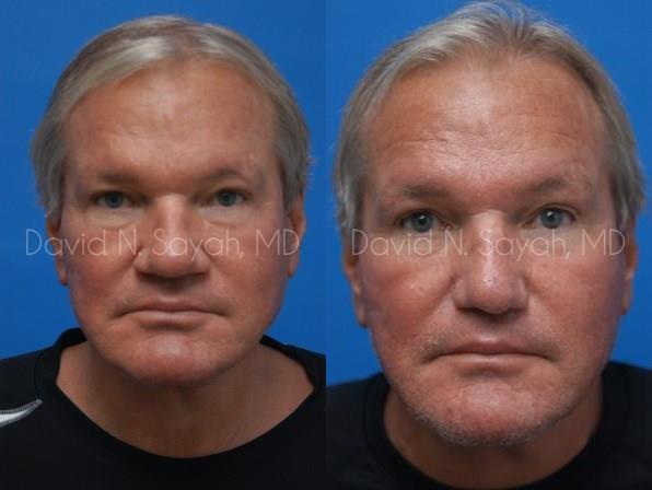 Rhinoplasty Before and After | simply males