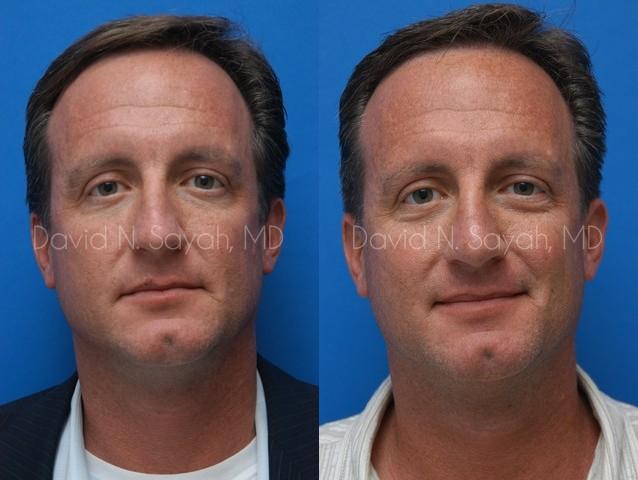 Rhinoplasty Before and After | simply males