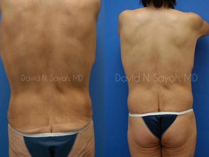 Back Tuck Belt Lipectomy Before and After | simply males