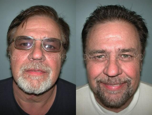 Neck Lift Before and After | simply males