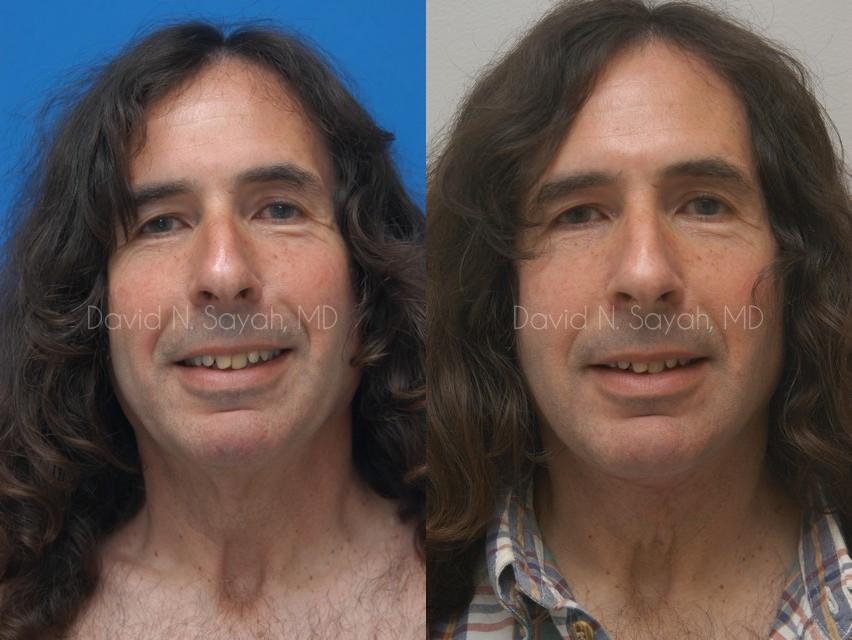 Neck Lift Before and After | simply males