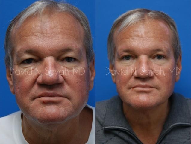 Neck Lift Before and After | simply males