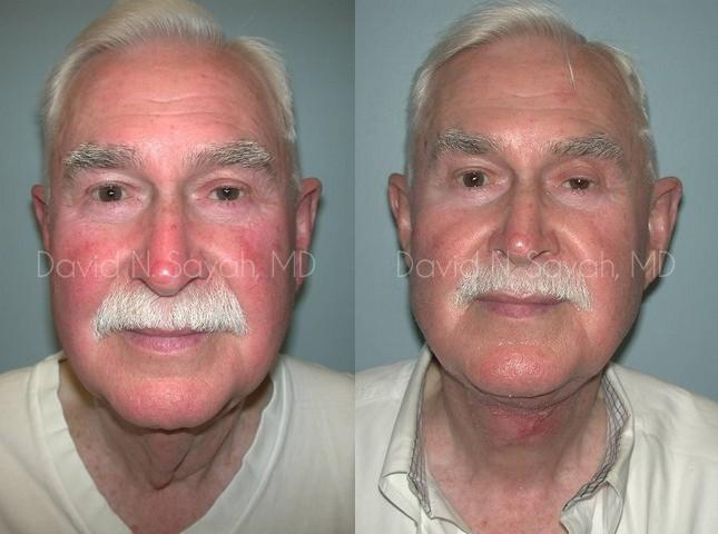 Neck Lift Before and After | simply males
