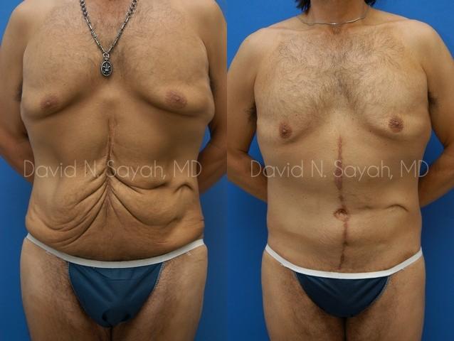Body Lift Before and After | simply males