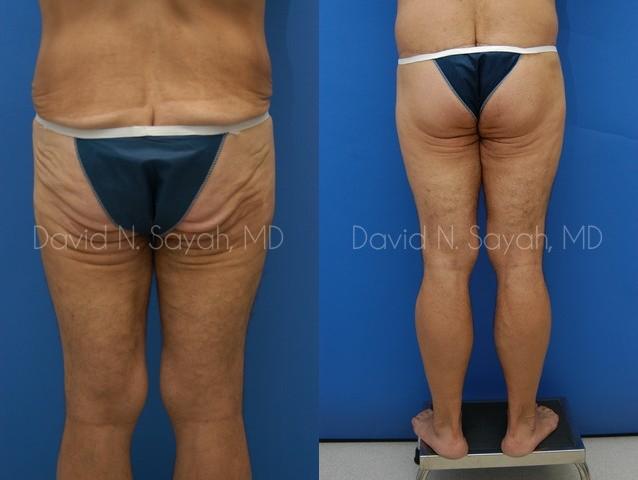 Buttock Lift Before and After | simply males
