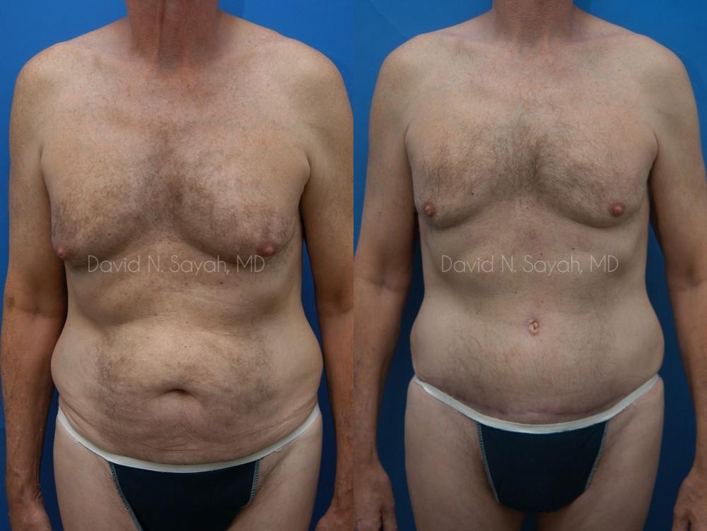 Tummy Tuck Before and After | simply males
