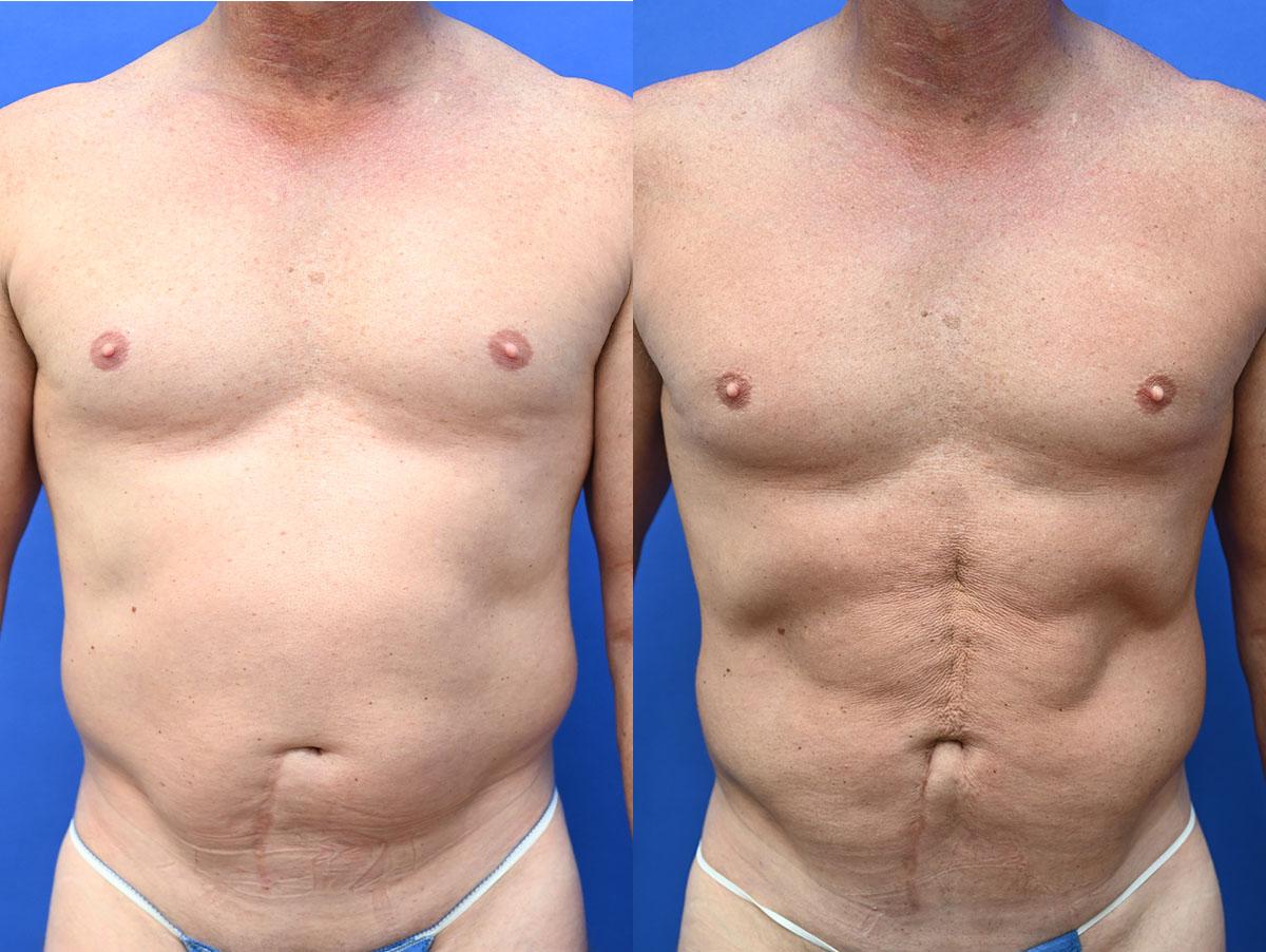 Liposuction Before and After | simply males