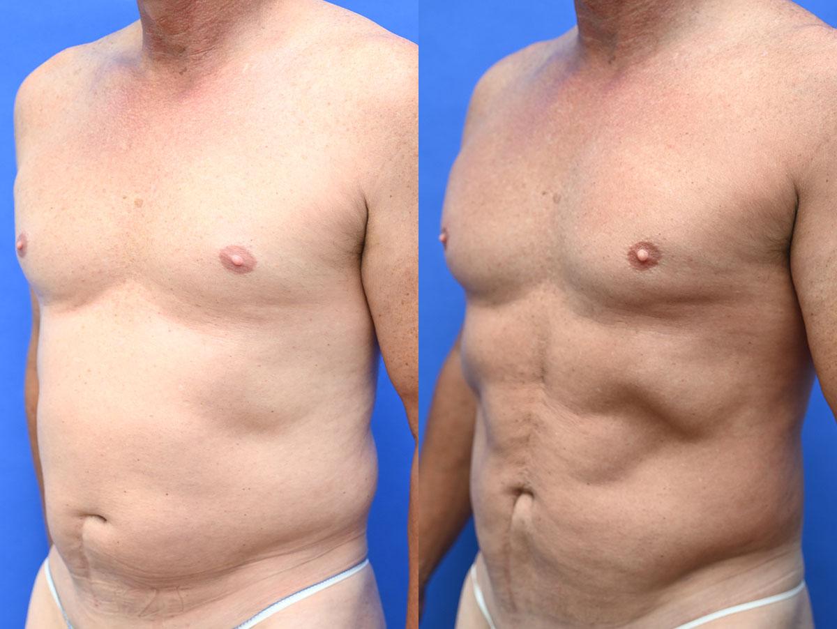 Liposuction Before and After | simply males