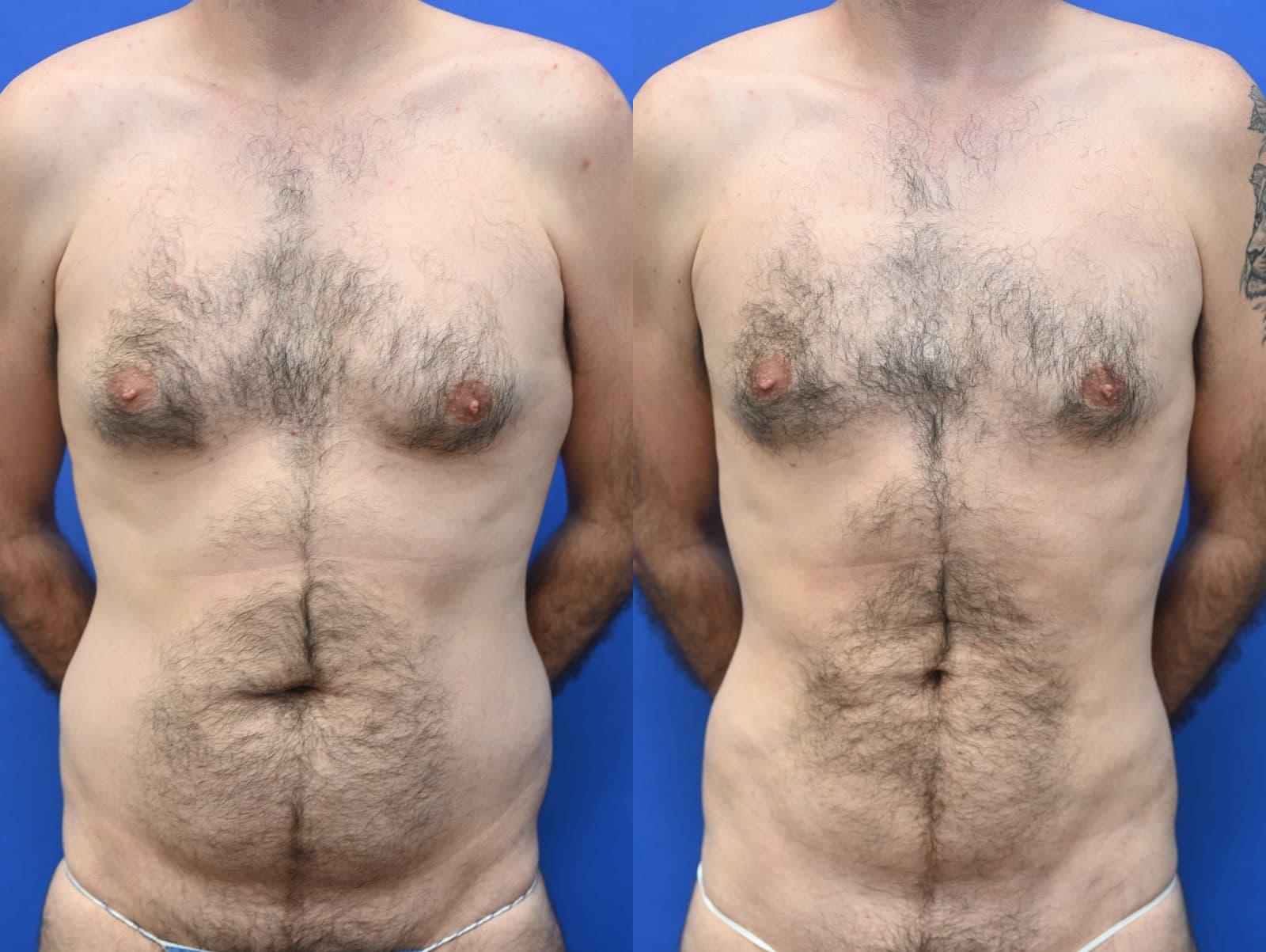 Liposuction Before and After | simply males