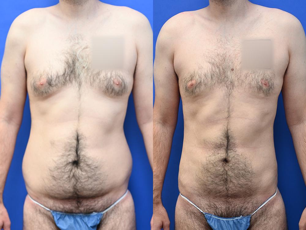 Liposuction Before and After | simply males