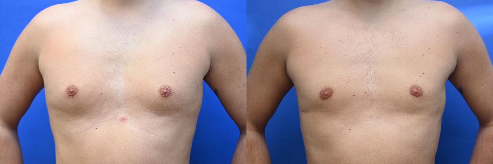 Gynecomastia Before and After | simply males