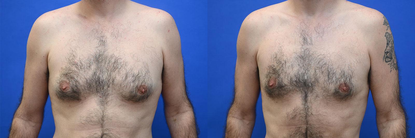 Gynecomastia Before and After | simply males