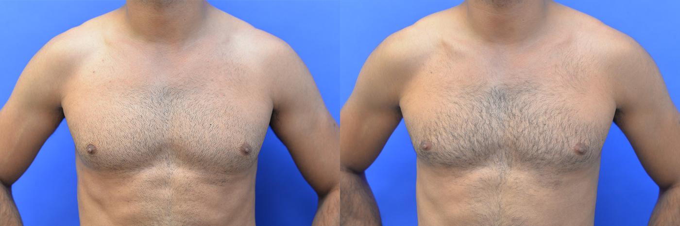 Gynecomastia Before and After | simply males