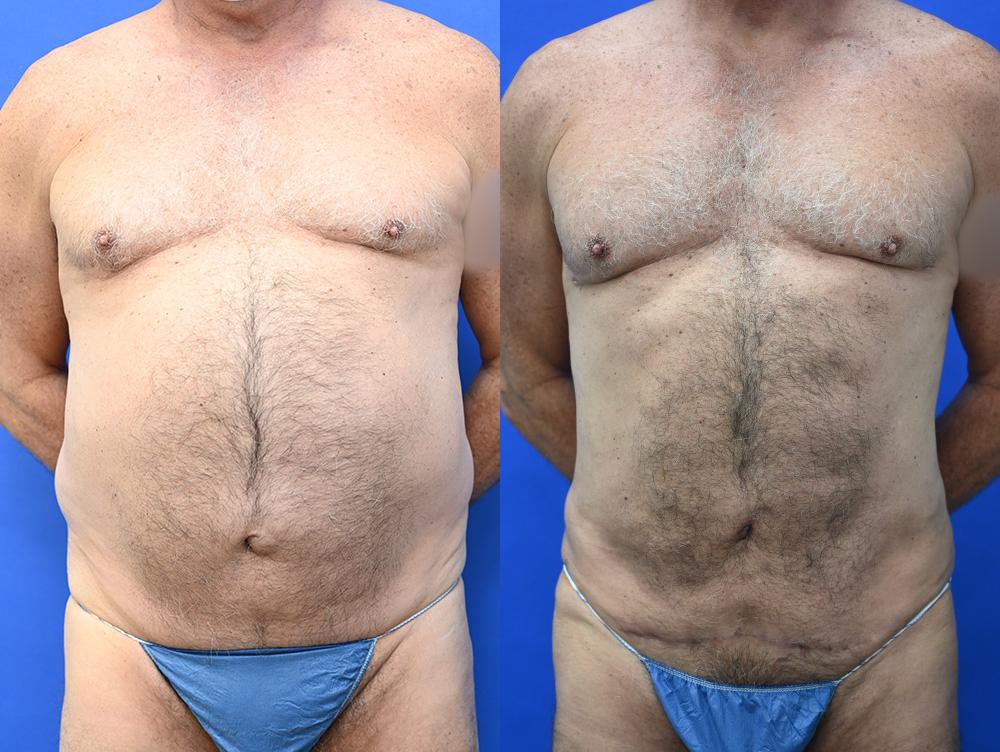 Gynecomastia Before and After | simply males