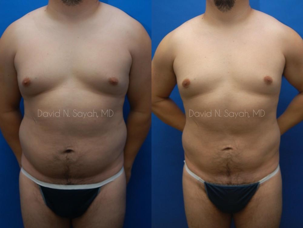 Liposuction Before and After | simply males
