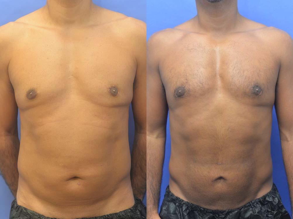 Liposuction Before and After | simply males