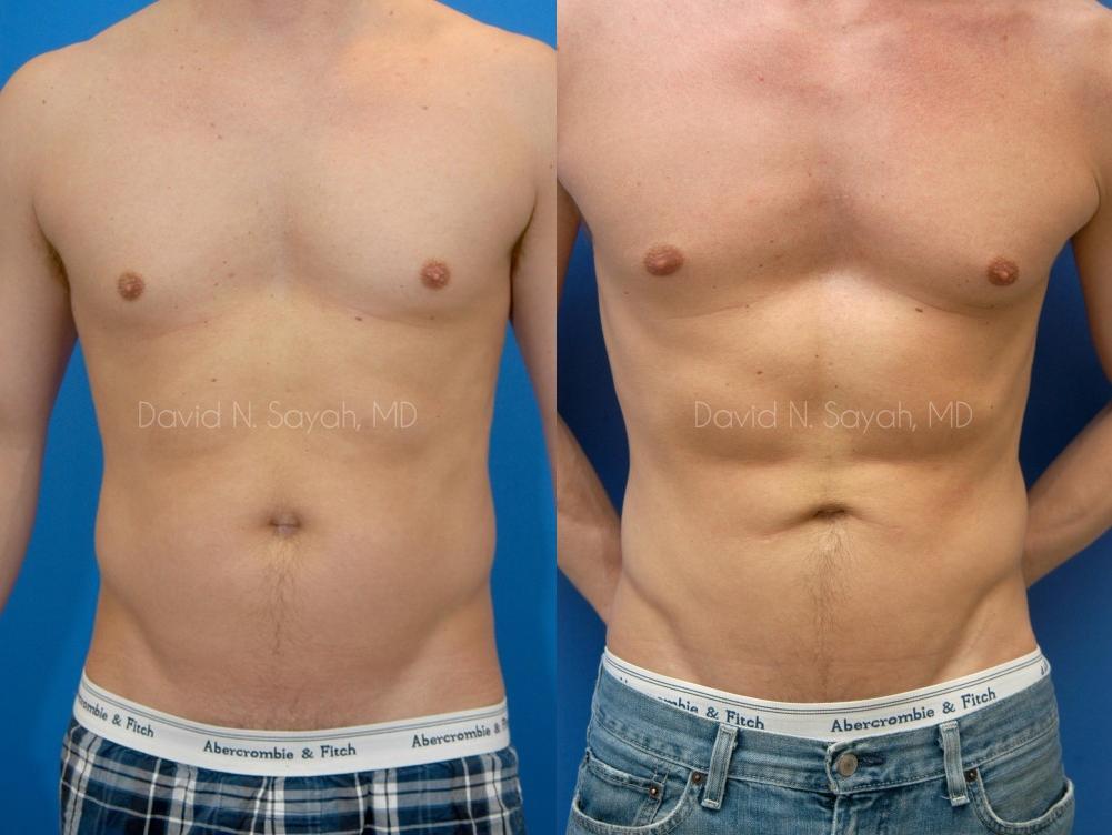 Liposuction Before and After | simply males