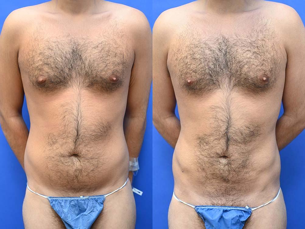 Liposuction Before and After | simply males