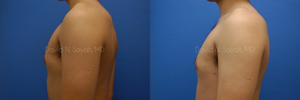 Liposuction Before and After | simply males