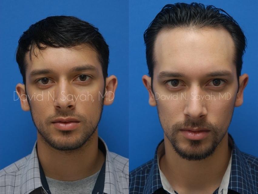 Ear Surgery Before and After | simply males