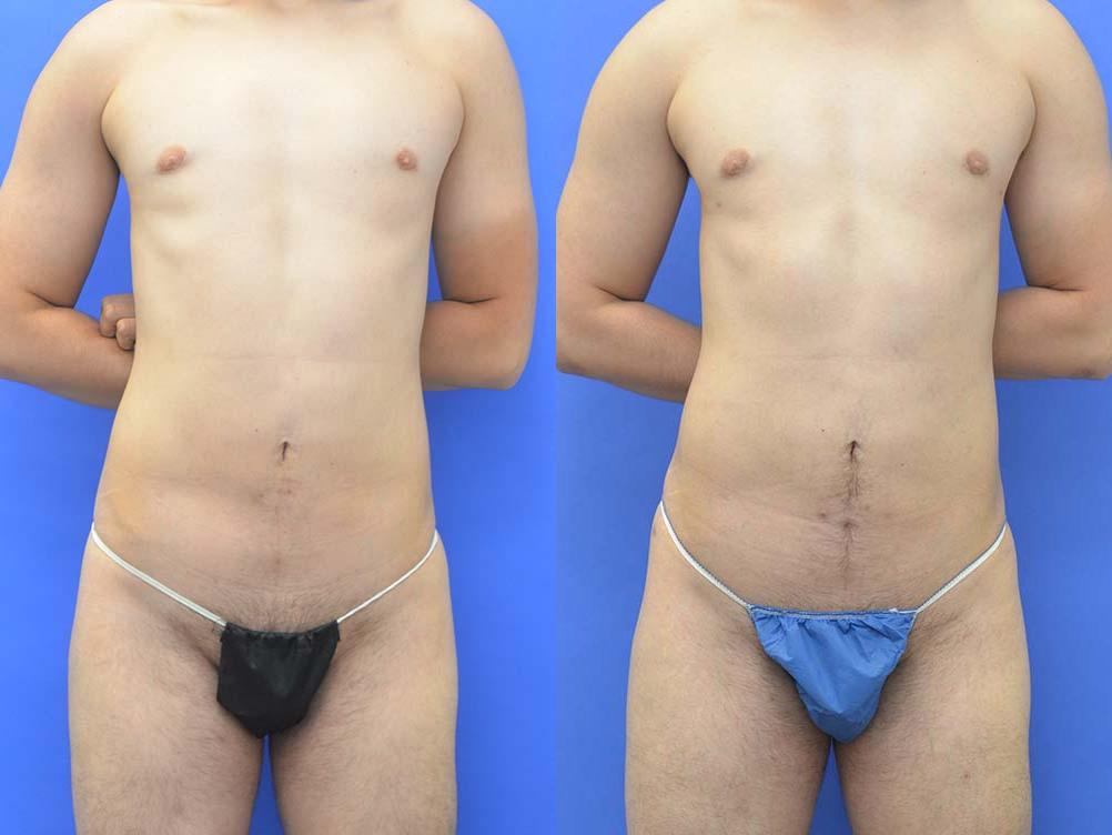Liposuction Before and After | simply males
