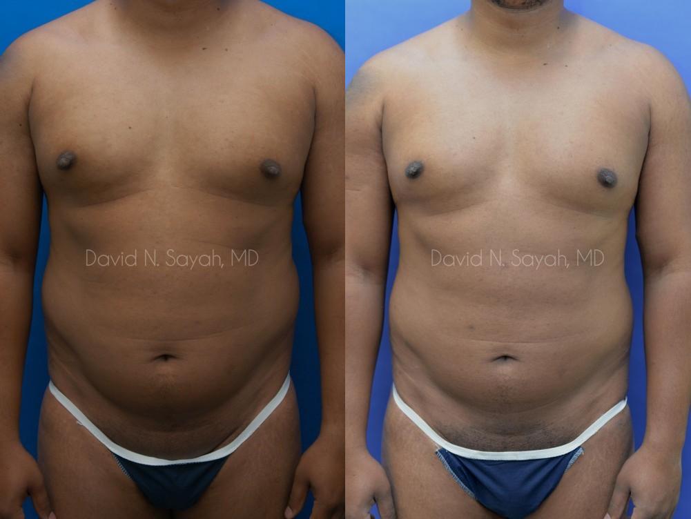 Liposuction Before and After | simply males