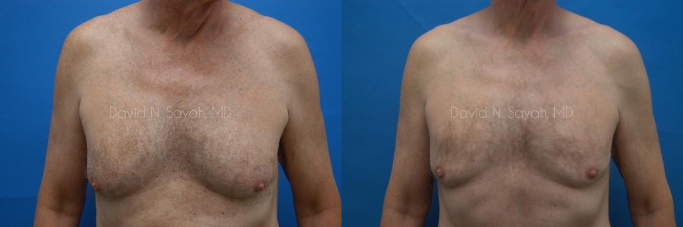 Liposuction Before and After | simply males