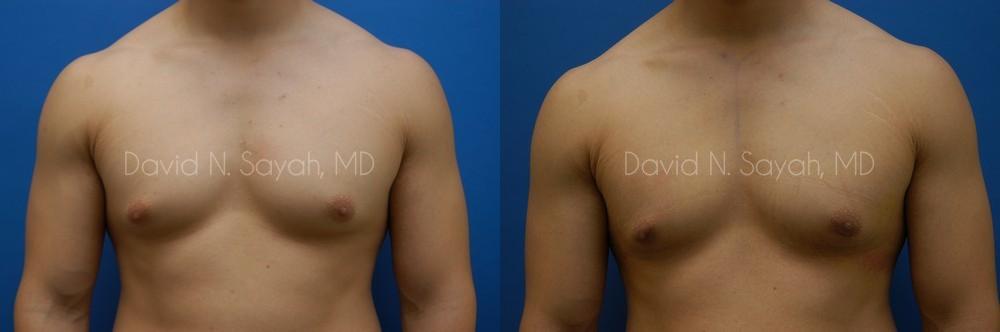Liposuction Before and After | simply males