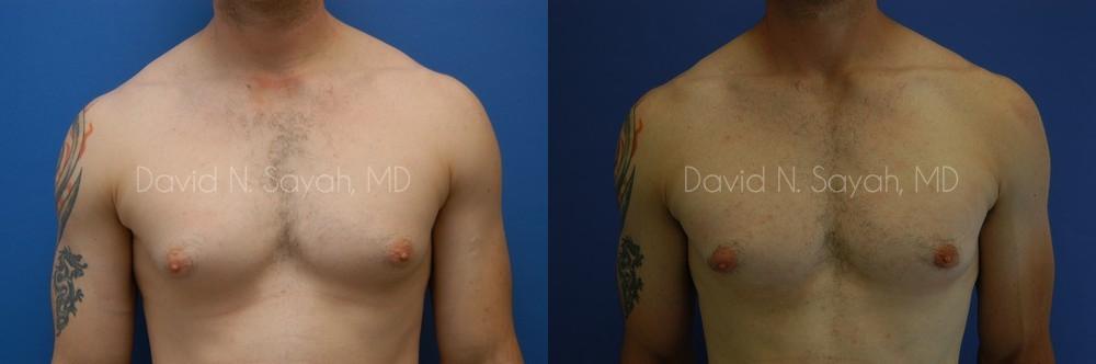 Liposuction Before and After | simply males