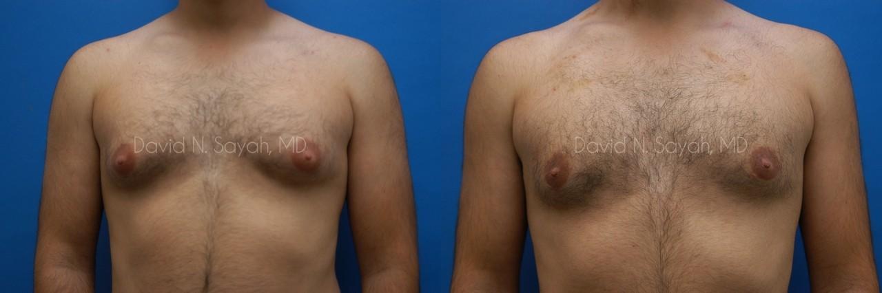 Liposuction Before and After | simply males