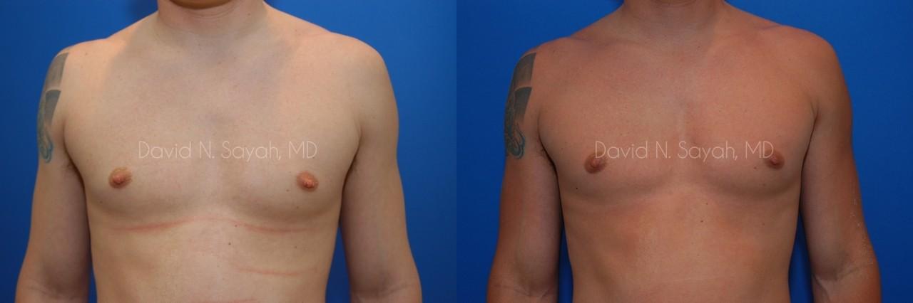 Liposuction Before and After | simply males