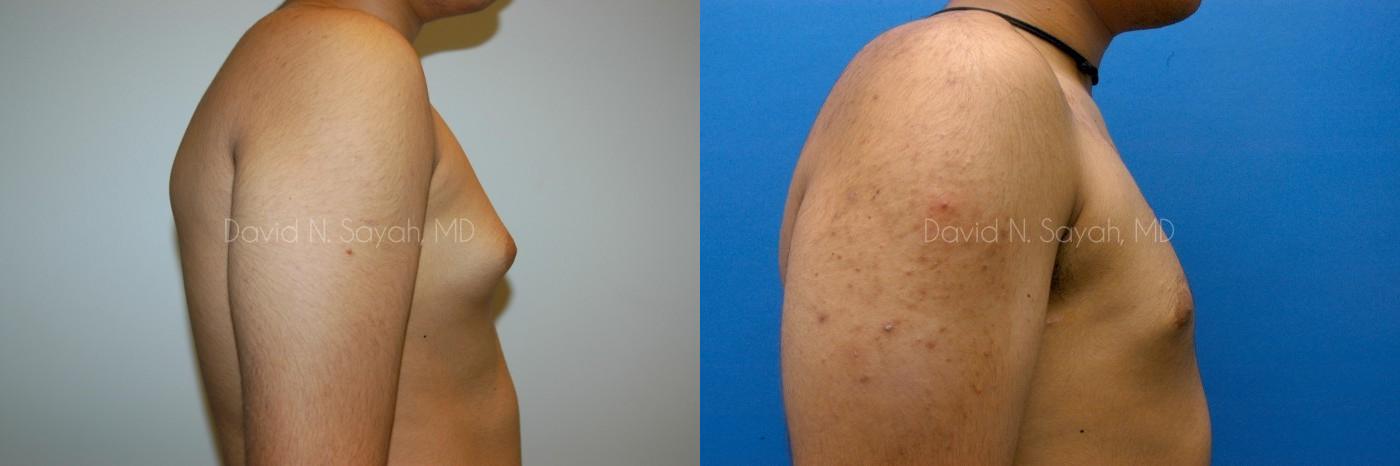 Liposuction Before and After | simply males