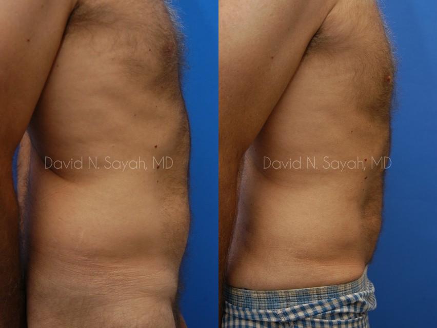 Liposuction Before and After | simply males