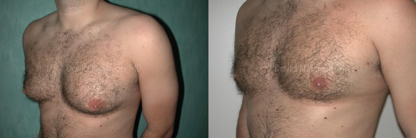 Liposuction Before and After | simply males