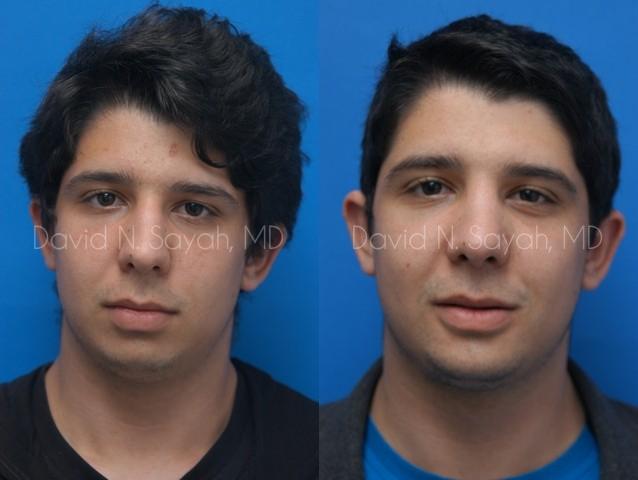 Chin Implant Before and After | simply males