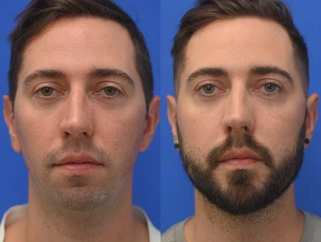 Chin Implant Before and After | simply males