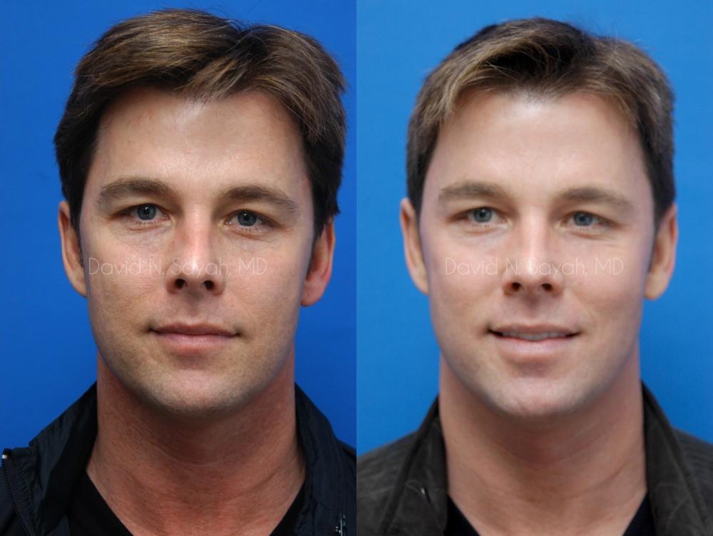 Co2 Laser Before and After | simply males