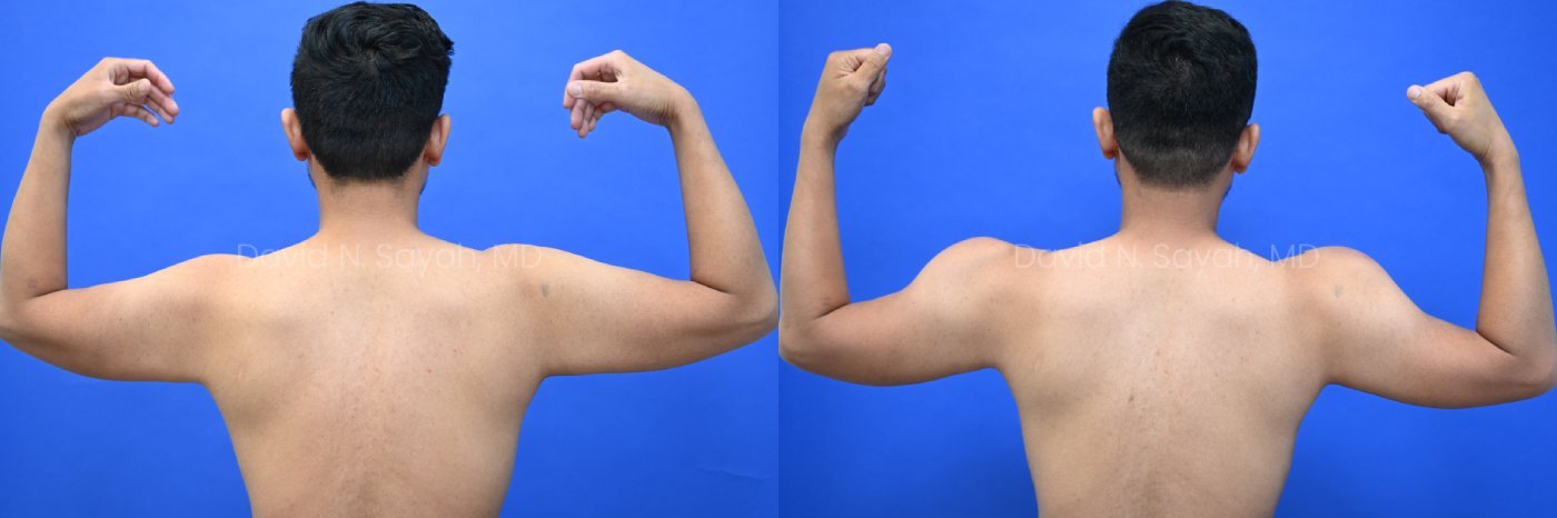 Side-by-side photos of a man from behind flexing his arms; left shows less muscle definition, right shows increased muscle tone against a blue background.